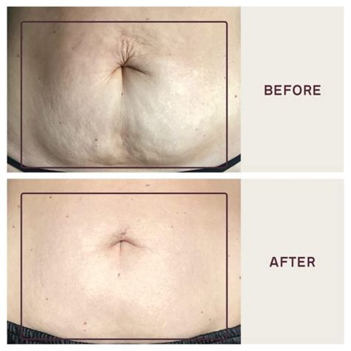Celebrating Beauty: BBW With Stretch Marks