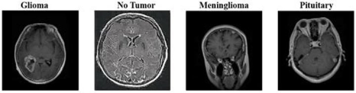 Uncovering The Enigma Of Sherry Holmes' Brain Tumor: A Detailed Examination