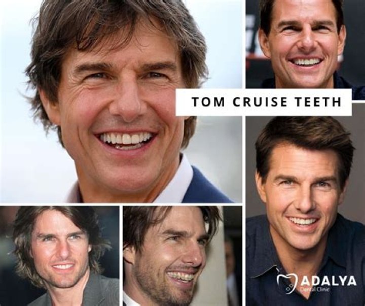 Unveiling The Smile: The Story Behind Tom Cruise's Veneers