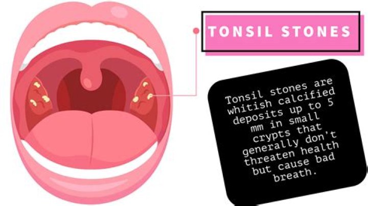 Unveiling The Tonsil Stones TikTok Phenomenon: What You Need To Know